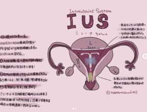 益若つばさなぜ避妊具を装着した？実際の痛みや口コミとどうやって子宮内にいれるか調査